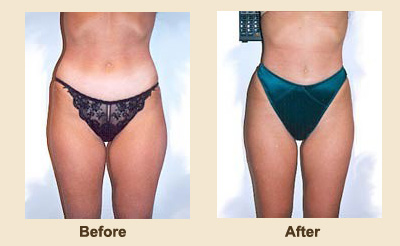 Before & After Liposculpture - Liposuction in New Jersey