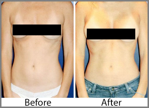 A Cup to B Cup, Breast Augmentation A to B