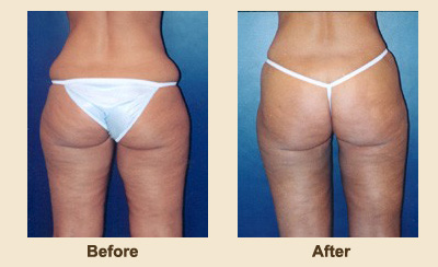 Before and After New Jersey Liposuction