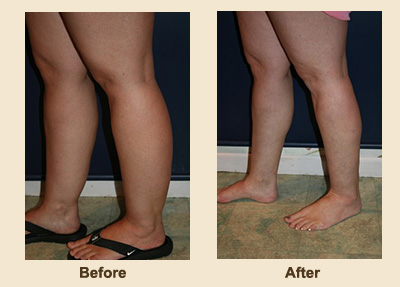 Calf Liposuction Results in Chester, New Jersey