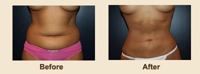 Chester NJ Before & After Liposculpture - Liposuction