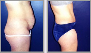 new jersey tummy tuck results 