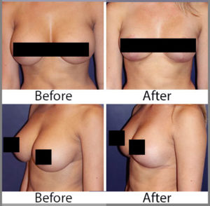 Breast Reduction Censored