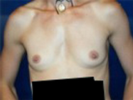 Breast Augmentation Patient 85947 Photo 1