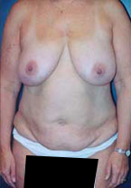 Liposuction Patient 89213 Photo 1