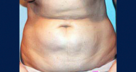 Liposuction Patient 93464 Photo 3