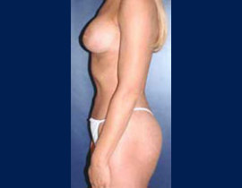 Breast Augmentation Patient 37298 Photo 4