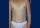 Breast Augmentation Patient 71805 Photo 1