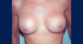 Breast Augmentation Patient 10774 Photo 2