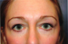 Eyelid Surgery Patient 72165 Photo 2