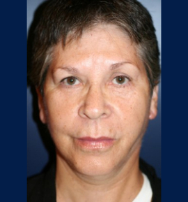 Facial Fillers Patient 75153 Photo 4