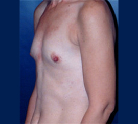 Breast Augmentation Patient 47366 Photo 3