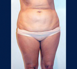 Liposuction Patient 93464 Photo 1