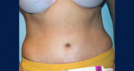 Liposuction Patient 93464 Photo 4