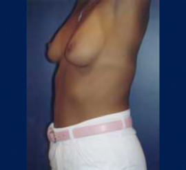 Breast Augmentation Patient 40591 Photo 3