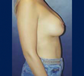 Breast Augmentation Patient 40591 Photo 6