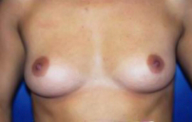Breast Augmentation Patient 77064 Photo 1