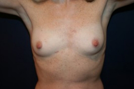 Breast Augmentation Patient 34551 Photo 1