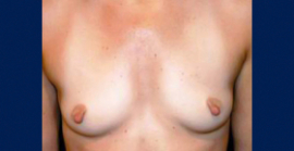 Breast Augmentation Patient 50649 Photo 5