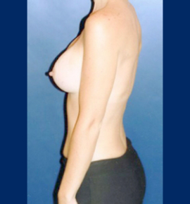 Breast Augmentation Patient 39285 Photo 4