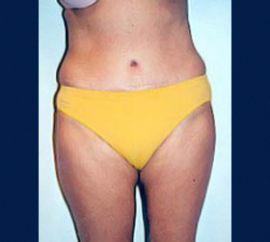 Liposuction Patient 93464 Photo 2