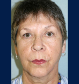 Facial Fillers Patient 75153 Photo 3