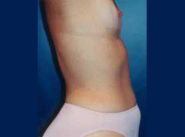 Breast Augmentation Patient 13513 Photo 5