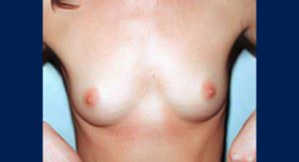 Breast Augmentation Patient 10774 Photo 1