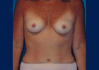 Breast Augmentation Patient 13513 Photo 1