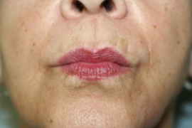 Facial Fillers Patient 75153 Photo 1