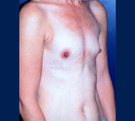 Breast Augmentation Patient 47366 Photo 1