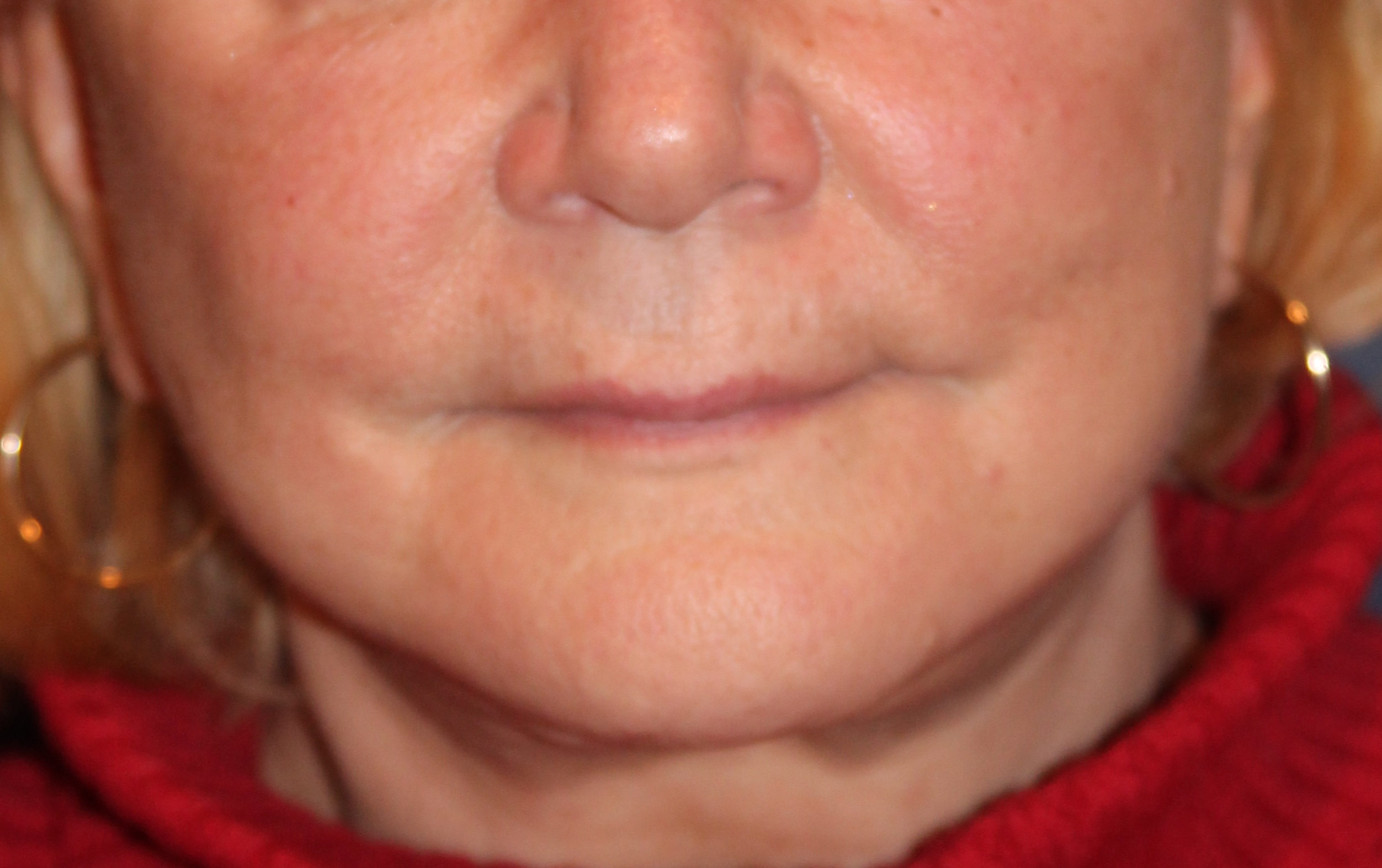 image of Marianne who after a thread lift at Weinstein Plastic Surgery center
