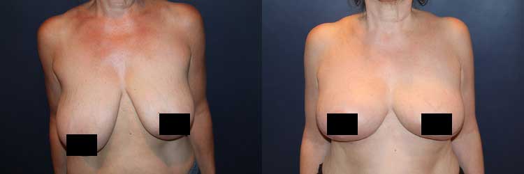 breast lift before and after picture - by Dr. Larry Weinstein