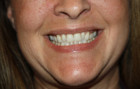 Facial Fillers Patient 80214 Photo 1