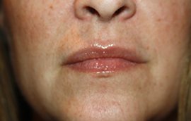 Facial Fillers Patient 80214 Photo 2