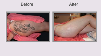Laser Tattoo Removal Before & After Photo