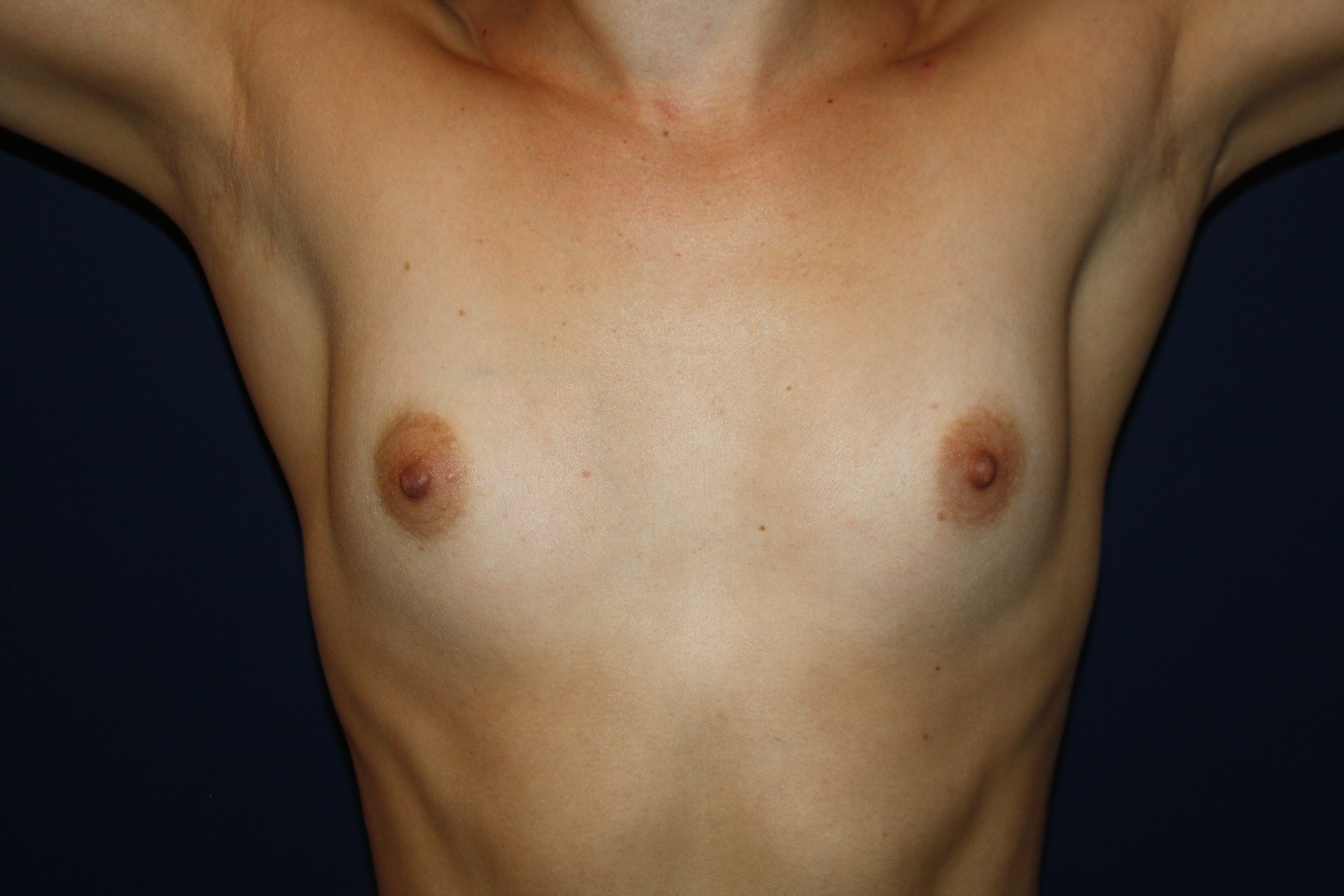 Breast Augmentation Patient 16193 Photo 1